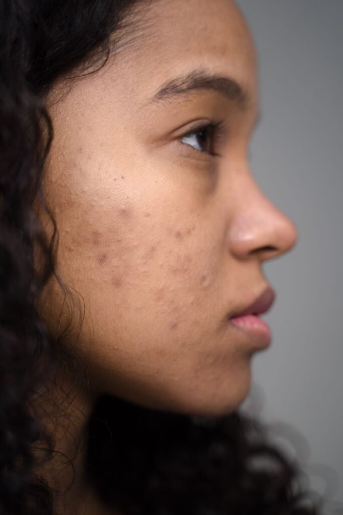 Close-up side profile of a woman's cheek and jawline showing natural skin with acne