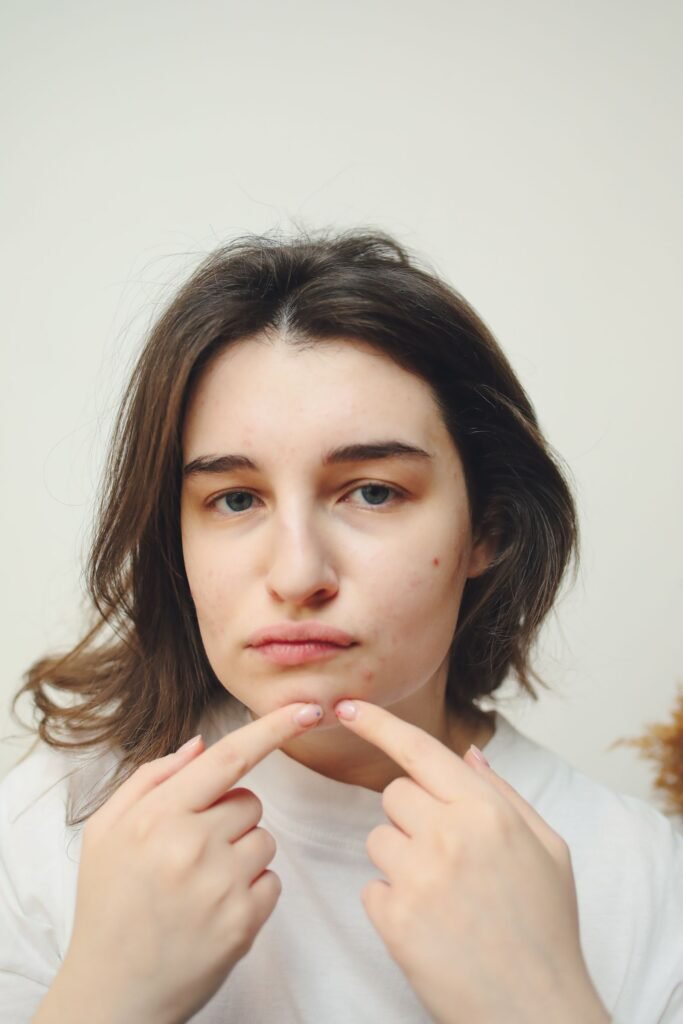 Young woman with breakouts on her chin and jawline, showing the typical hormonal acne pattern